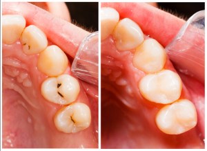 dental fillings can help restore teeth with decay