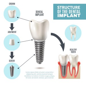 dental implants replace the root system of natural teeth