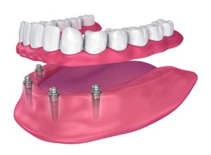 a denture can be secured to the lower jaw with dental implants