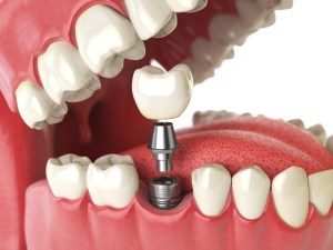 dental implants can support a replacement tooth crown