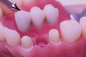 dental bridges rely on neighboring teeth for support