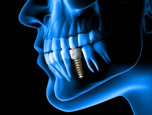 dental implants are secured into jaw bone