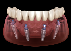 Dental implants in lower jaw