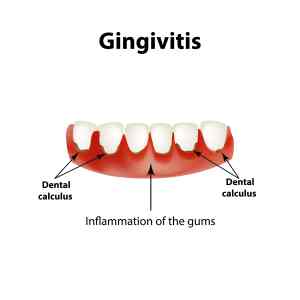 Gingivitis inflammation gums dental calculus infographics