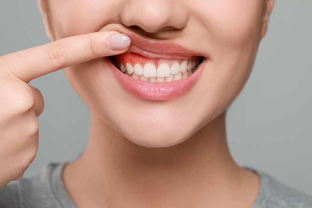 Woman showing inflamed gum on grey