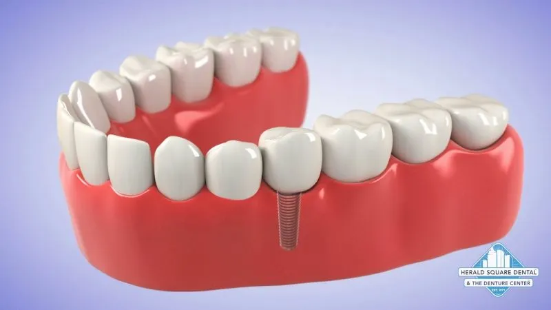 The Denture Center: Bridge vs. Implant Video Thumbnail